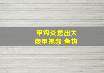 甲沟炎挖出大嵌甲视频 鱼钩